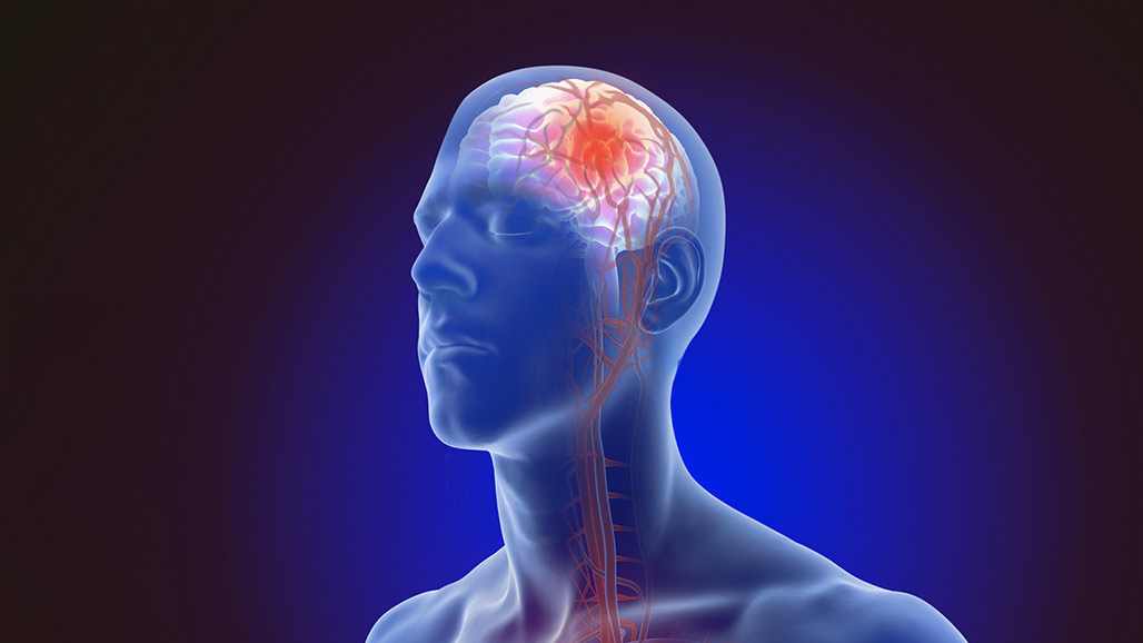 Time is Brain says Urgent Need for Faster Stroke Care