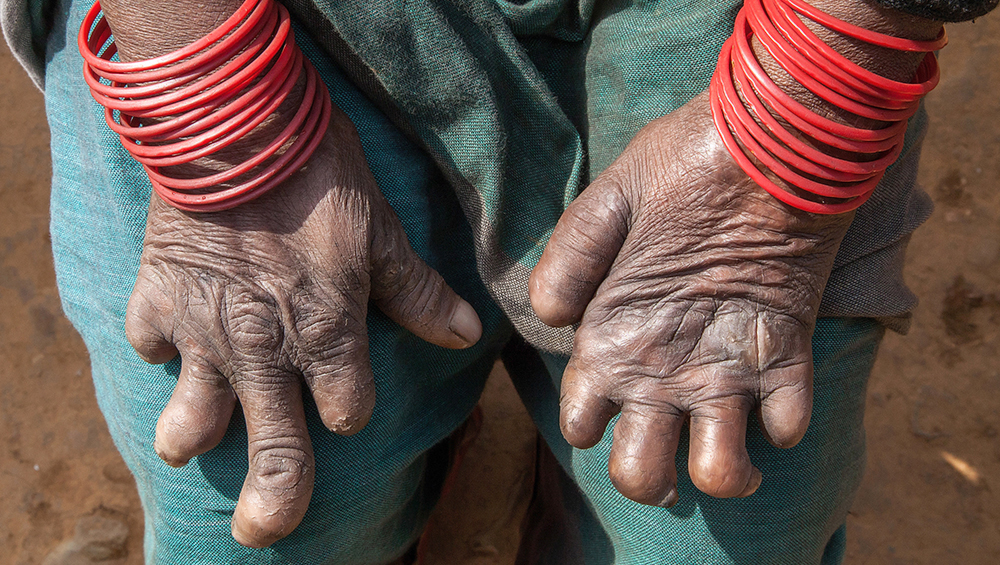 Maharashtra to Survey Over 8.5 Crore Citizens for Leprosy and TB
