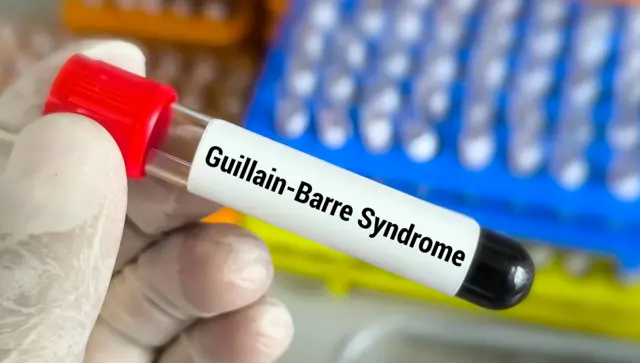 Guillain-Barré Syndrome Death Toll in Pune Rises to Six; Caseload Hits 173